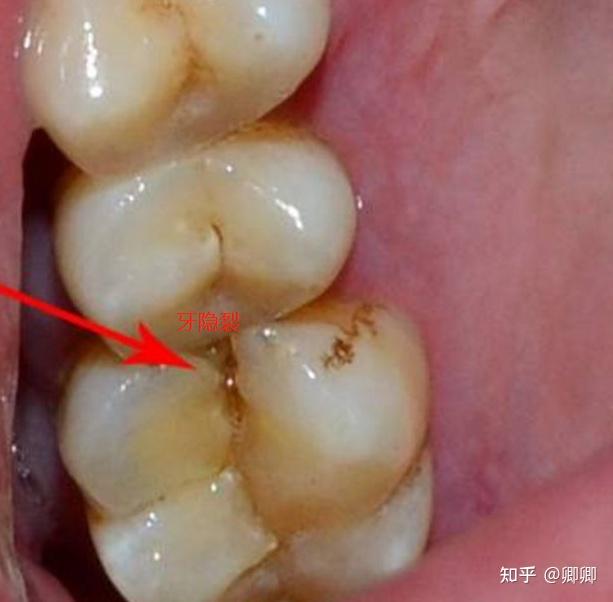 牙隱裂當患者有牙周炎時,牙齦萎縮,牙根暴露牙頸部有些地方沒有牙