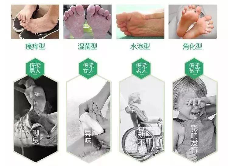 一双鞋重点是脚臭会传染,不及时"隔离"一系列让你觉得心烦的症状糜烂