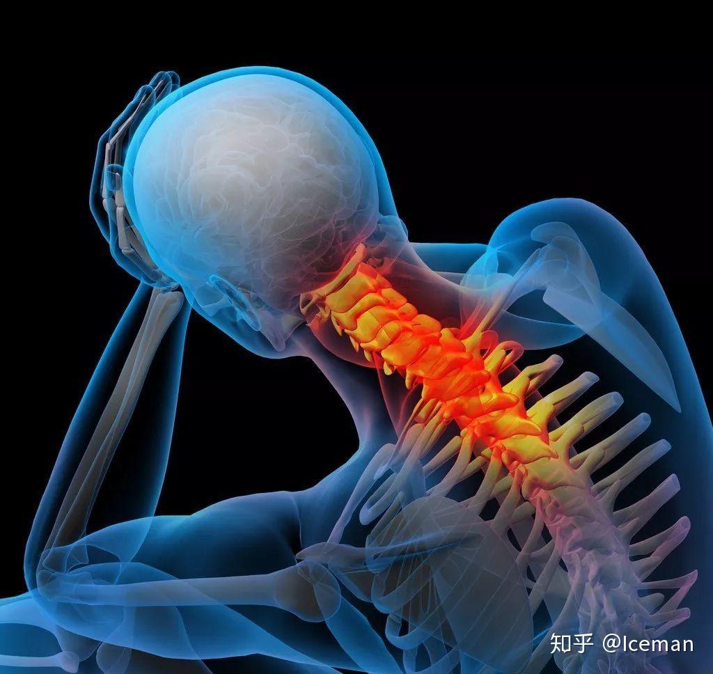 颈椎间盘突出压迫神经根怎么治疗？颈椎手术第二年瘫痪 - 知乎