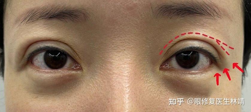 双眼皮术后眼头和眼尾出现分叉问题?怎么办?