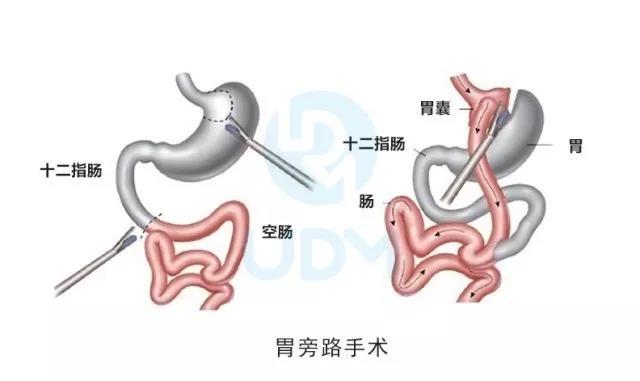 怎样才能治好胃溃疡 v2-3c3aec54dff7573410a55550e0c33fc9_1440w.jpg?source=172ae18b