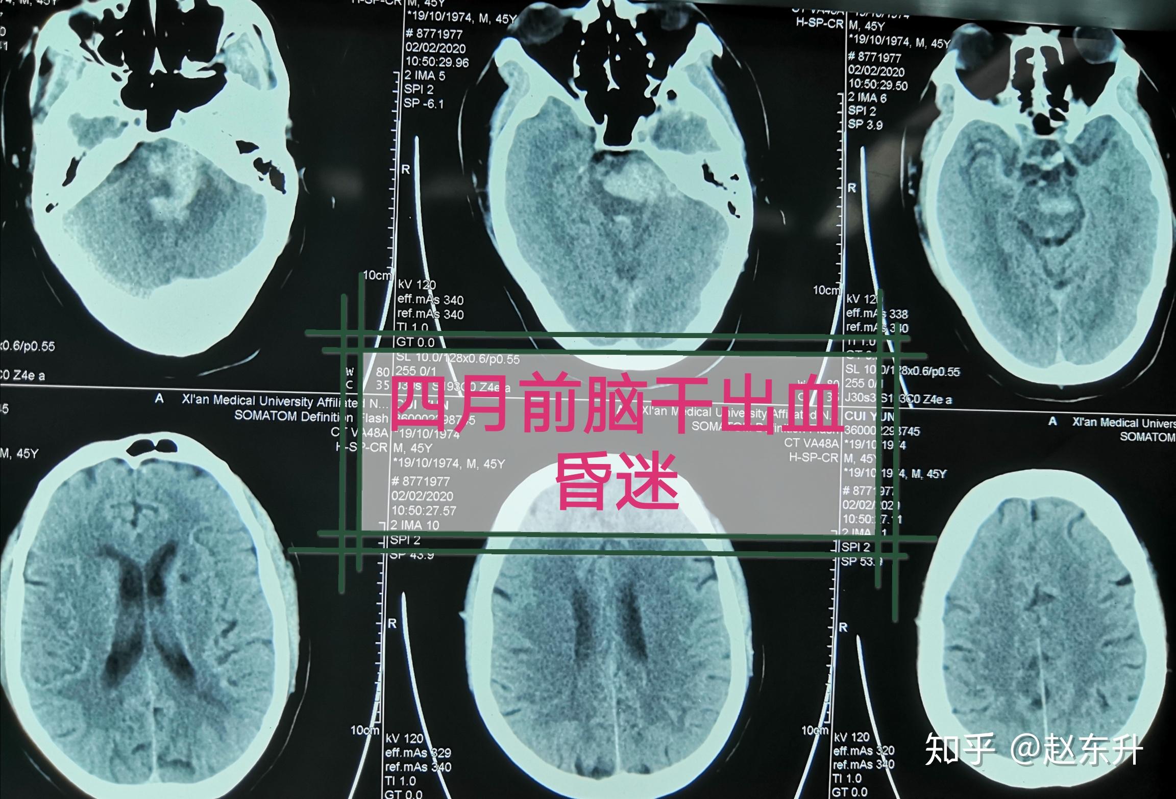 【疾病百科】放射性脑干损伤——早发现早治疗 - 脑医汇 - 神外资讯 - 神介资讯