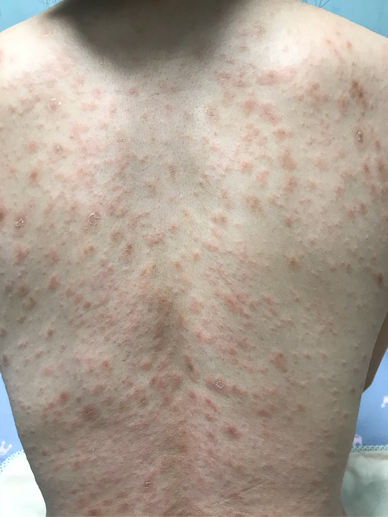 単純 性 粃 糠 疹 写真 得了玫瑰糠疹怎么办? - 知乎