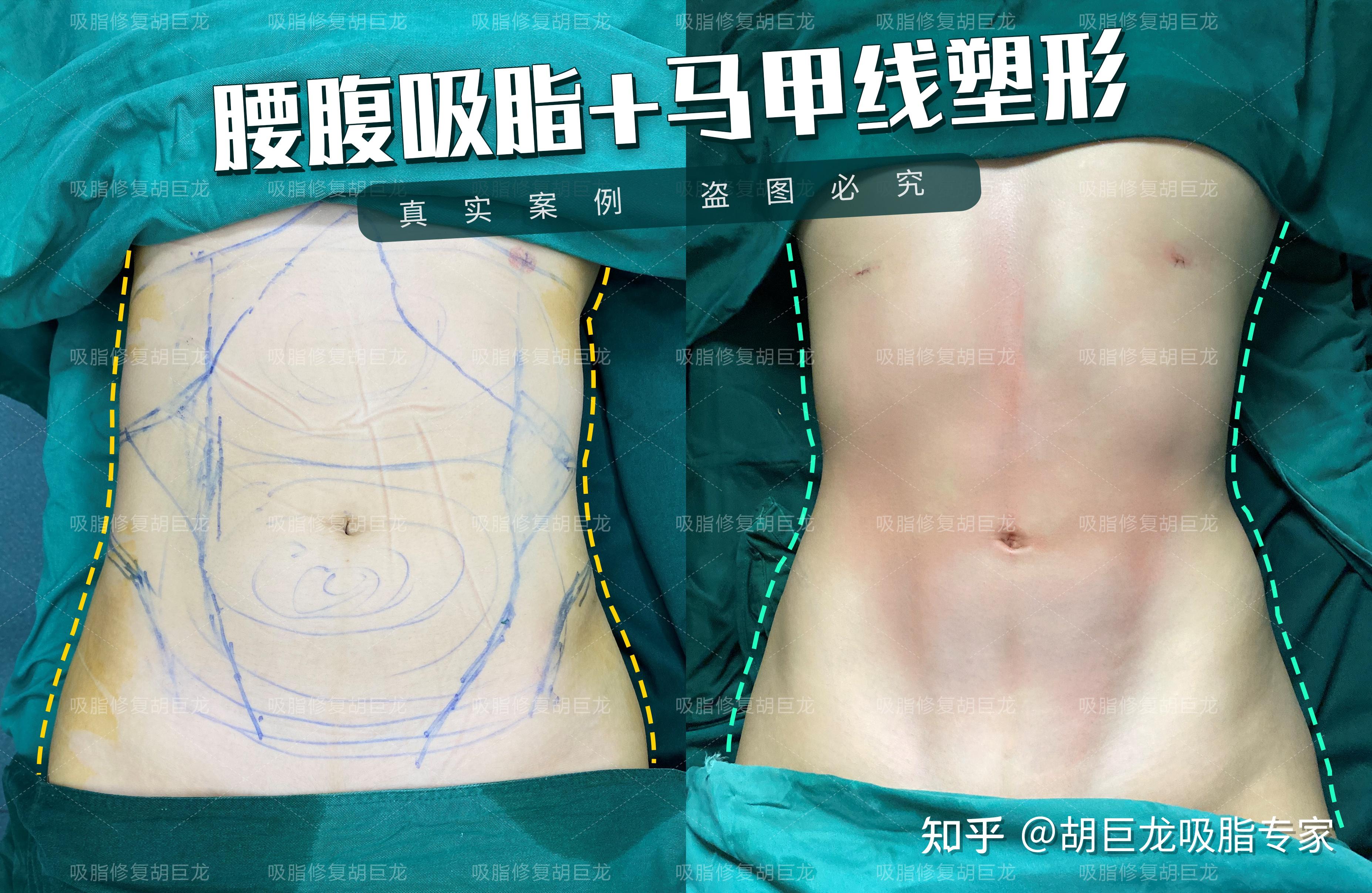 吸脂塑形h型腰身到完美马甲线的蜕变