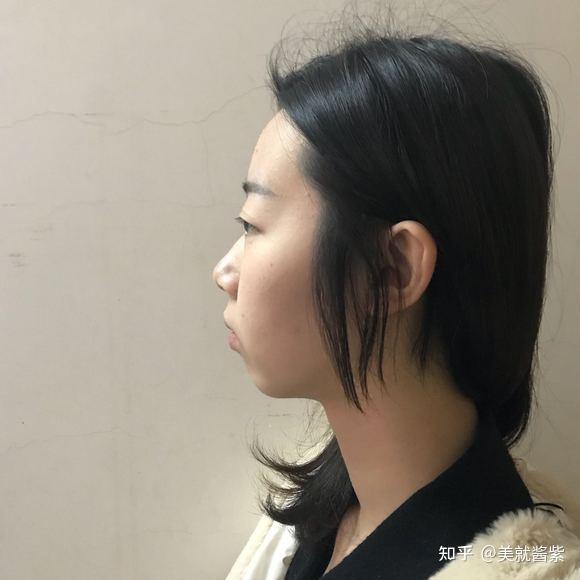 北京颏成型手术细节分享,没有对比就没有伤害! - 知乎