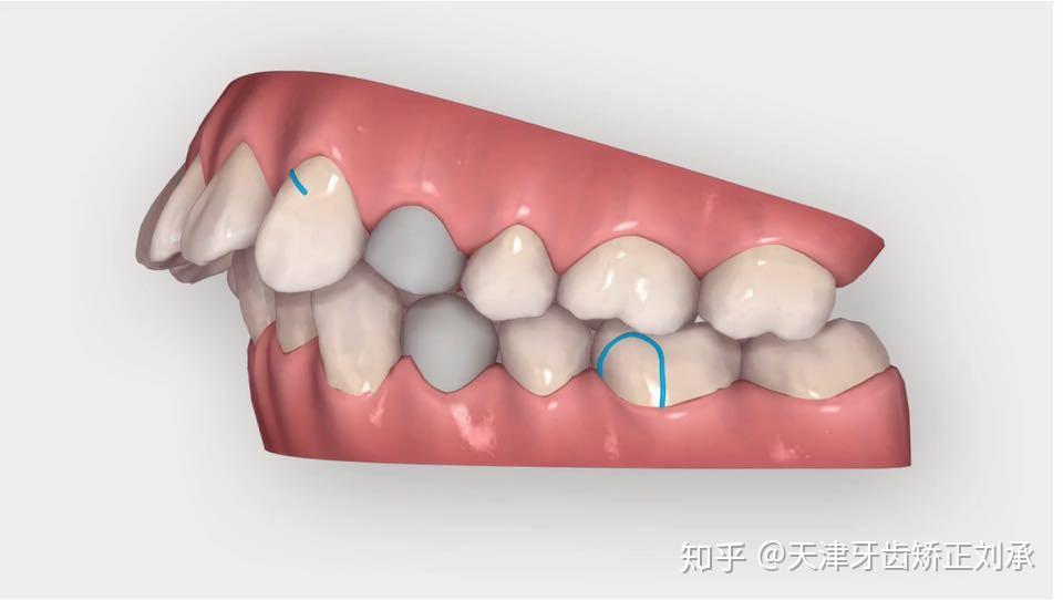 牙齿二类牵引示意图图片