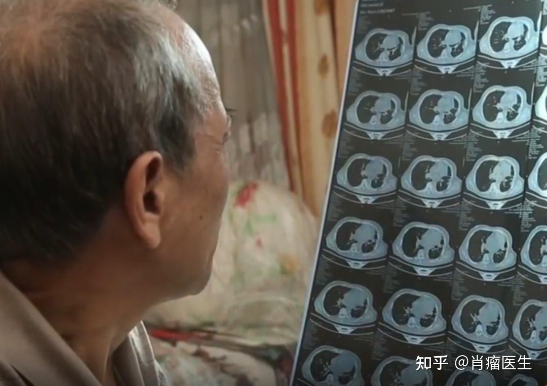 而且是4期b的晚期肺癌患者,医生告知该患者仅剩6个月至1年的生存时间