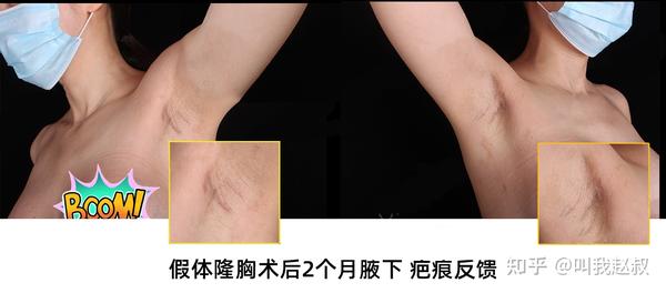 假体隆胸有3种切口方式,分别是腋下切口,下皱襞切口,乳晕切口.