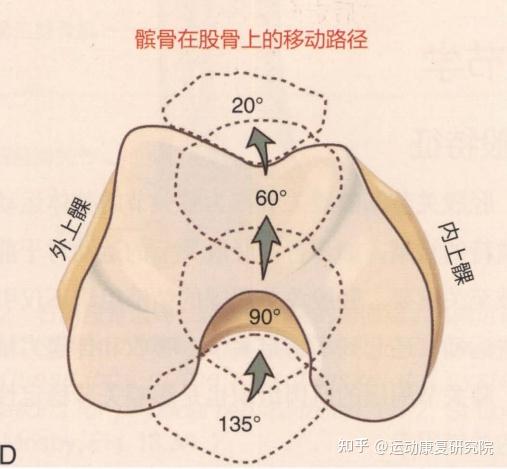 膝蓋疼痛髕骨位置偏斜才是罪魁禍首