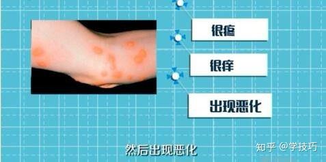 跳蚤叮咬和臭虫叮咬有什么区别