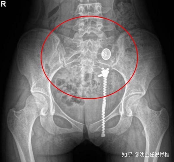 腰痛反复发作,活动受限?除了腰的问题,“骨盆错位”不容忽视 - 知乎