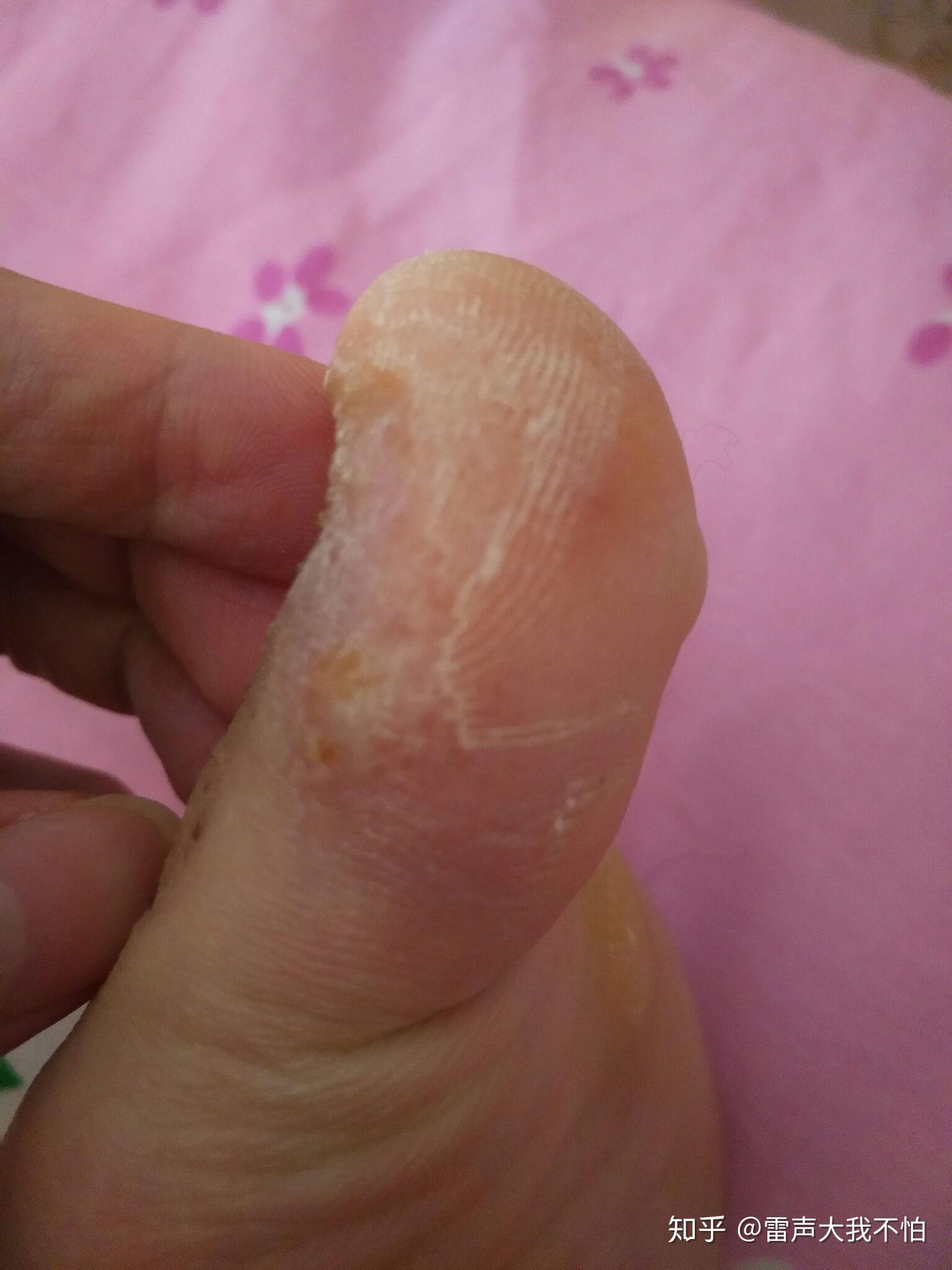 脚上这两天一直在起大水泡求大神诊断