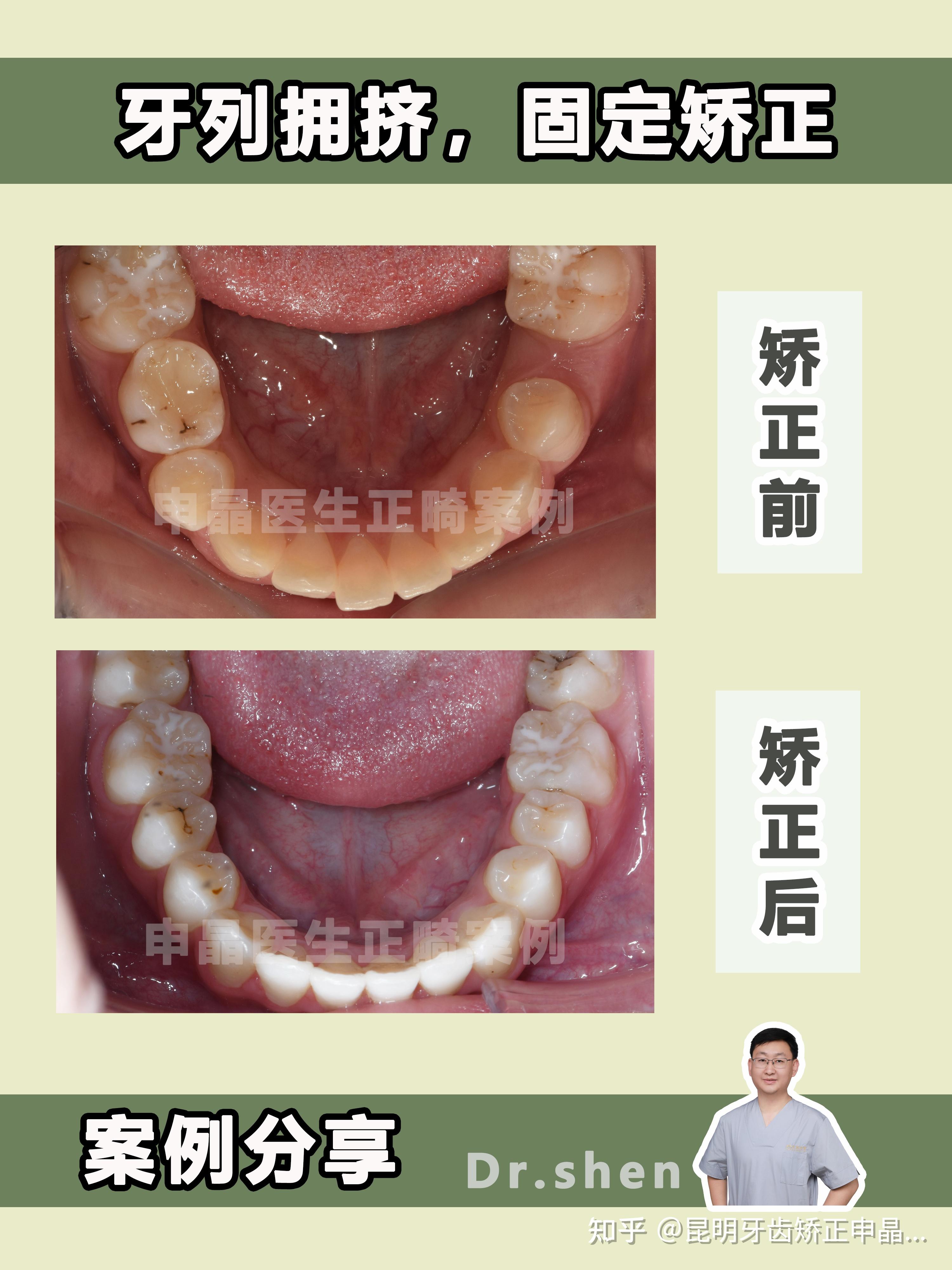 儿童牙齿矫治| 替牙期也有正畸必要! - 知乎