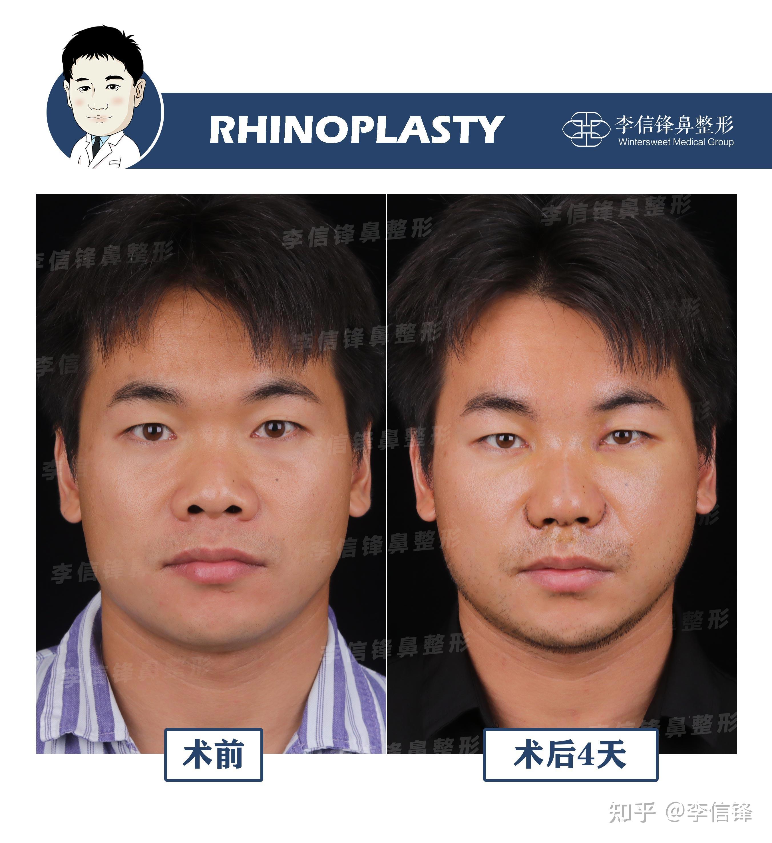 初鼻鼻综合,短塌鼻、鼻基底凹陷填充改善,术后四天对比~深圳李信锋隆鼻综合整形案例 - 知乎