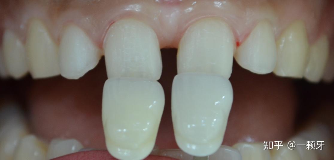 最美莫过唇红齿白牙齿美白之路