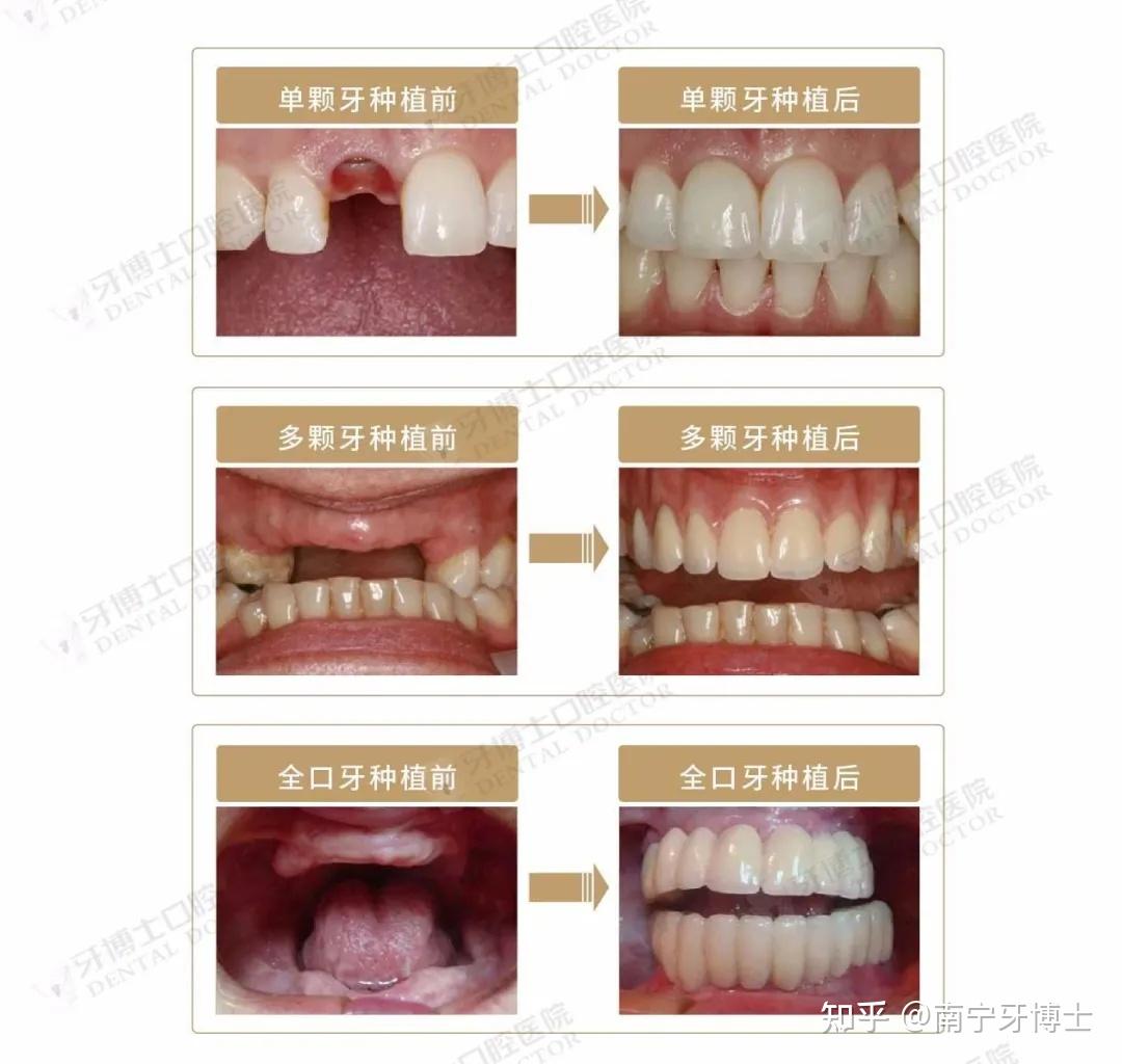 細數缺牙八宗罪缺牙修復刻不容緩