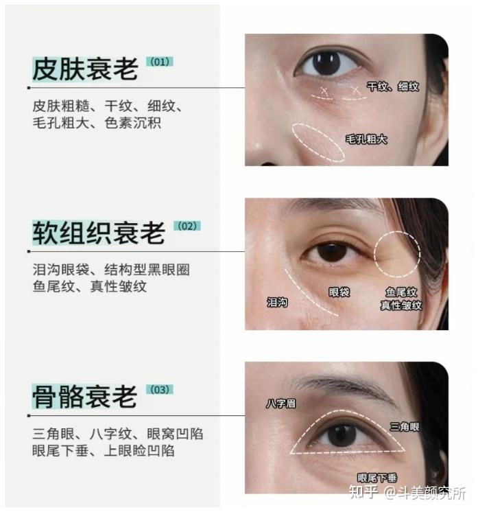 抗衰回报率最高的眼周,怎么打才最有效?进阶版的眼周固定提升打法,提升紧致的同时还保留了平整度!