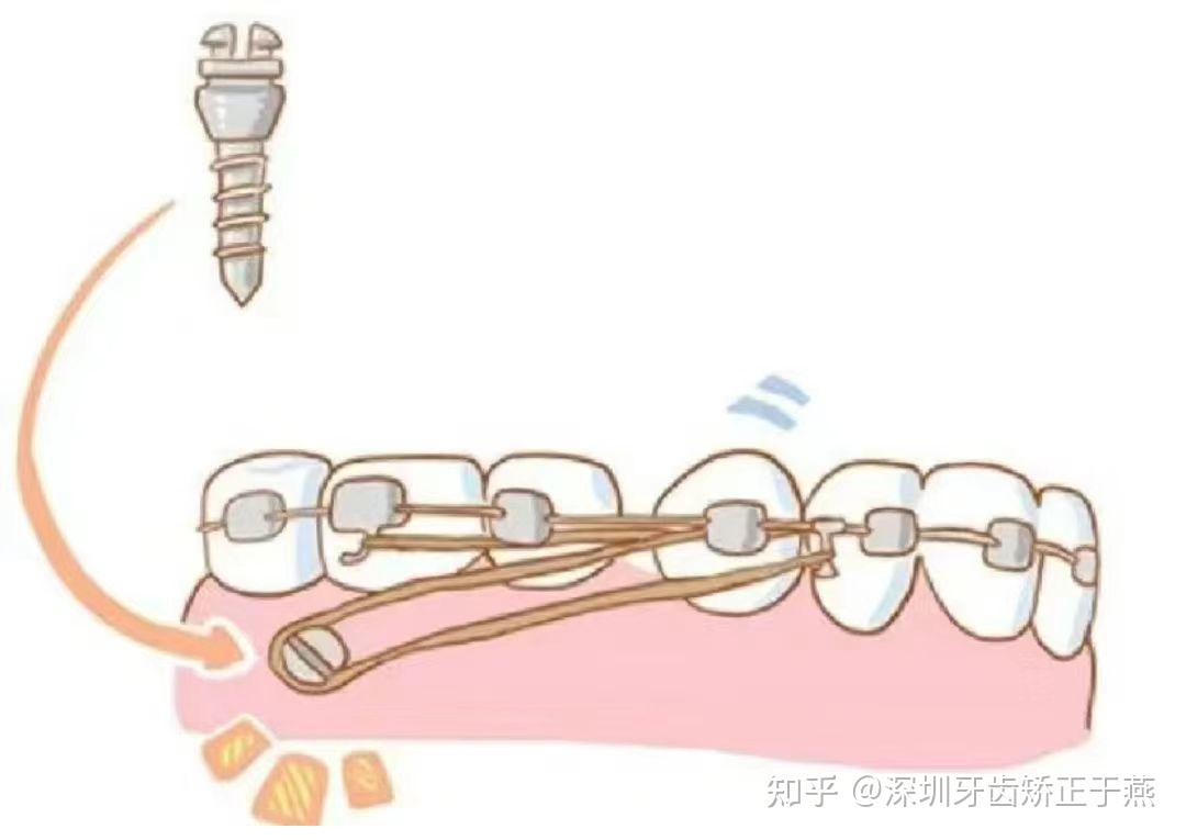牙齿矫正,打支抗钉(骨钉)是一种怎样的体验(上)? - 知乎
