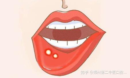 复发性口腔溃疡吃什么食物好