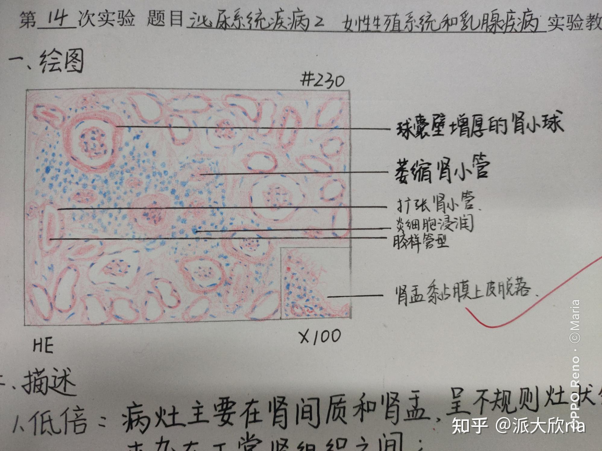 肾浊肿手绘实验报告图图片