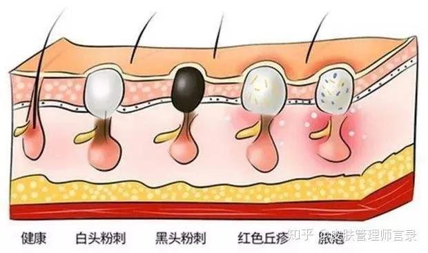 怎样才能减少痘痘生长? - 知乎
