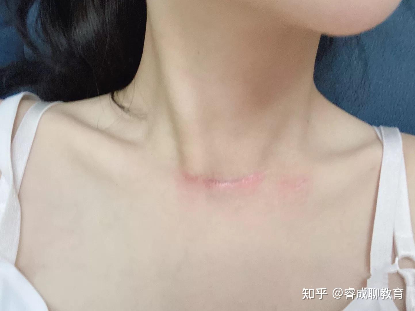 甲状腺手术后疤痕护理,如何才能不留疤 - 知乎