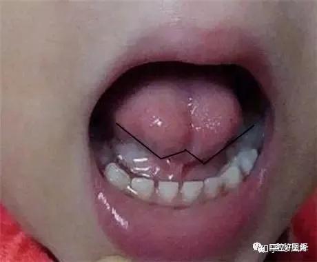 临床小窍门：舌系带延长术这样做，非常安全...