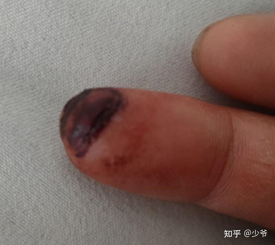 右手中指被砸破出血