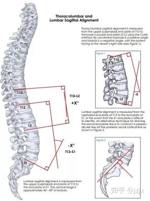 脊柱畸形角度测量 知乎