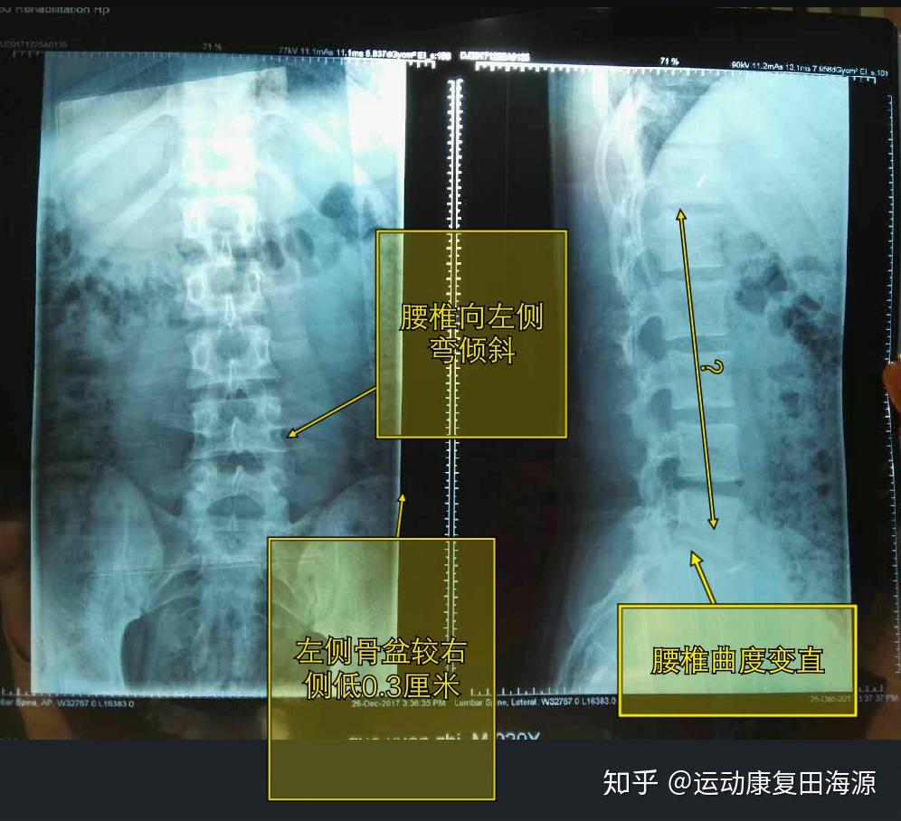 运动员的脊柱侧弯