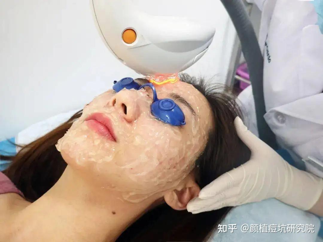 m22超光子如何有效治疗血管以及痘痘问题 - 知乎