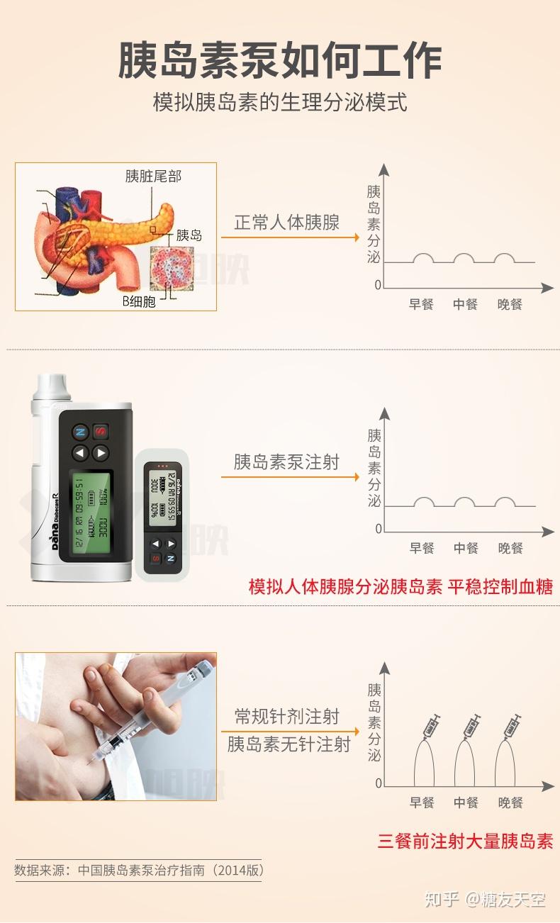 胰岛素泵使用方法图解图片