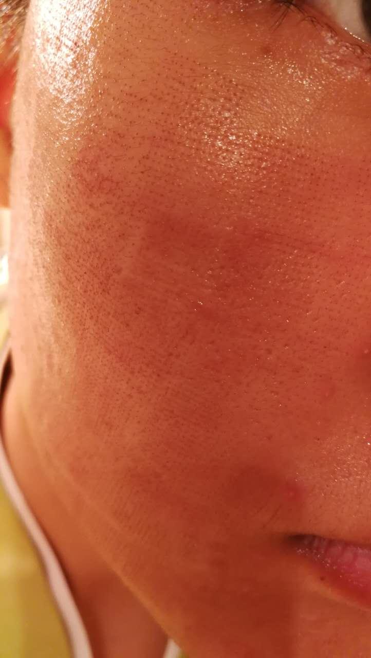 十年抗痘史一把辛酸泪点阵激光疗效持续更新