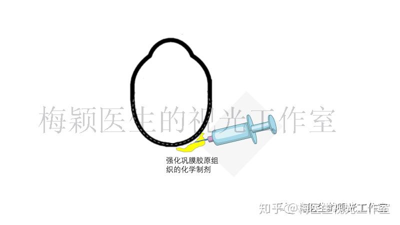 ssi是在眼球后极部的tenon囊下注射特殊的化学试剂(polyvinyl