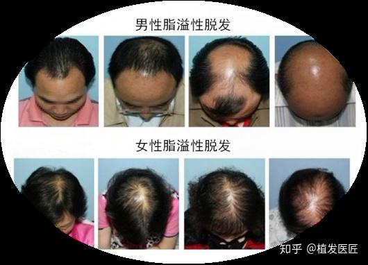 剃光头可以让头发增多吗？脂溢性脱发要怎么治疗呢？