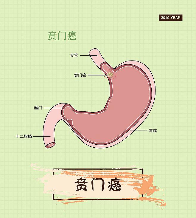 贲门癌是怎么引起的图片