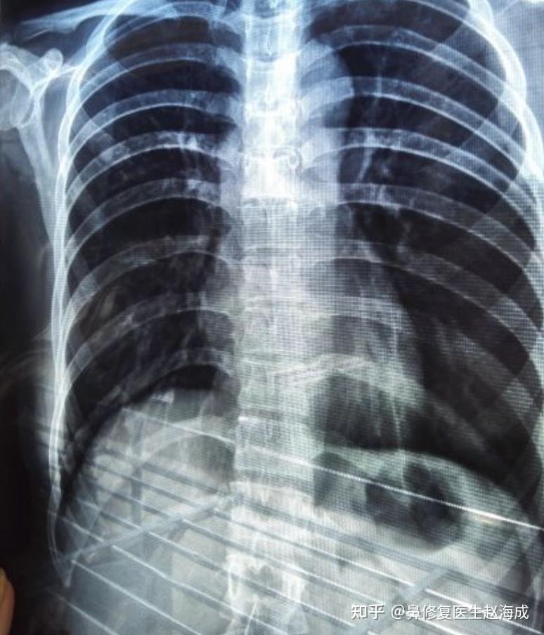 肋骨l鼻之前还有一个重要事项你知道吗