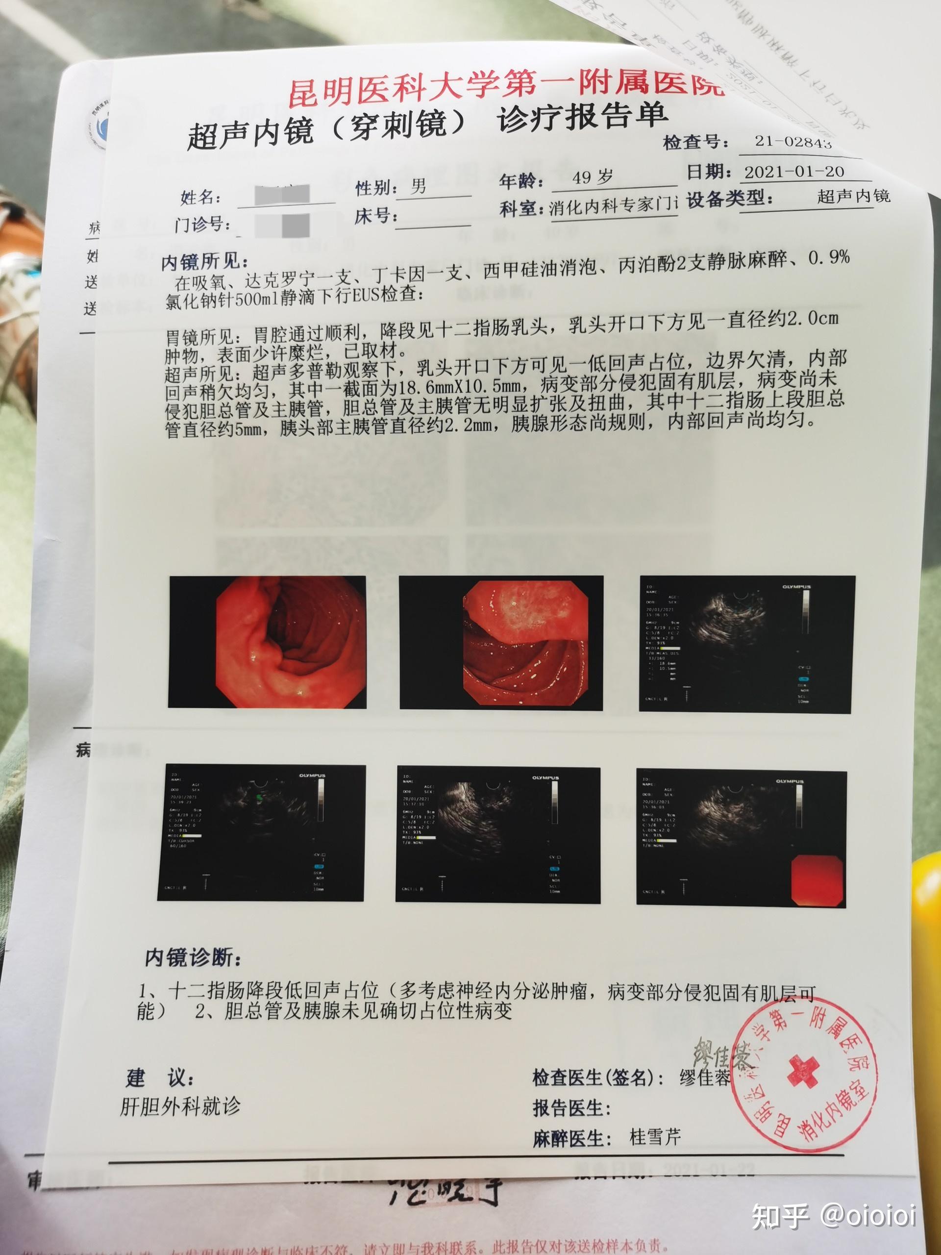 十二指肠间质瘤确诊及治疗 - 知乎