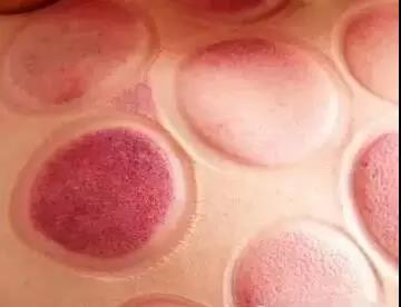 拔罐为什么会变紫 v2-3ed357f2af03f6436bf948866d26c63f_b.jpg