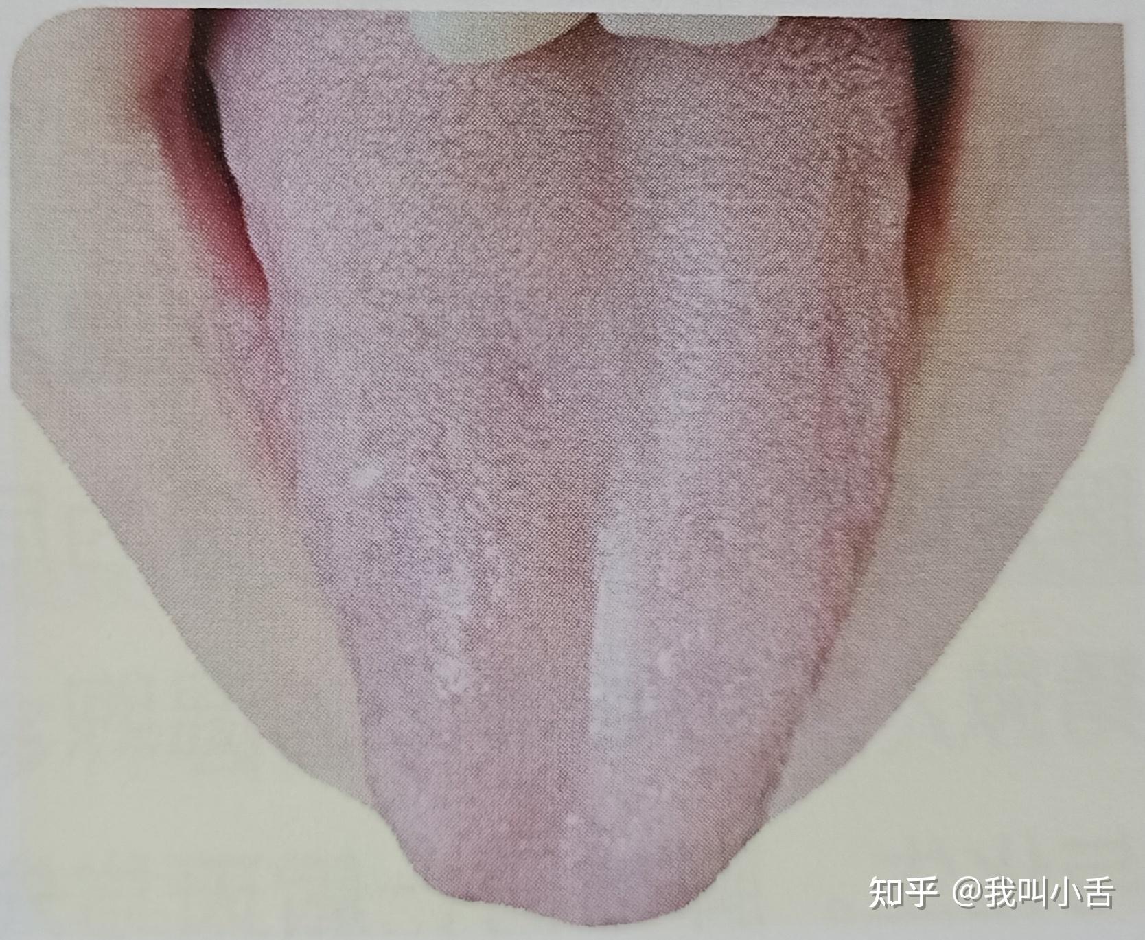 【見微知著】睇舌頭知健康（Part 1）！中醫：舌苔又白又厚、有齒印代表脾虛濕重-健康好人生 Health-經濟通 ET Net