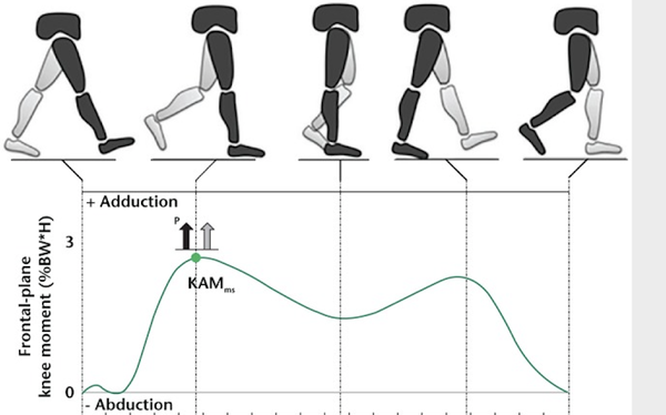 膝盖往里夹的角度(knee adduction moment) 可以看到骨关节炎患者的内