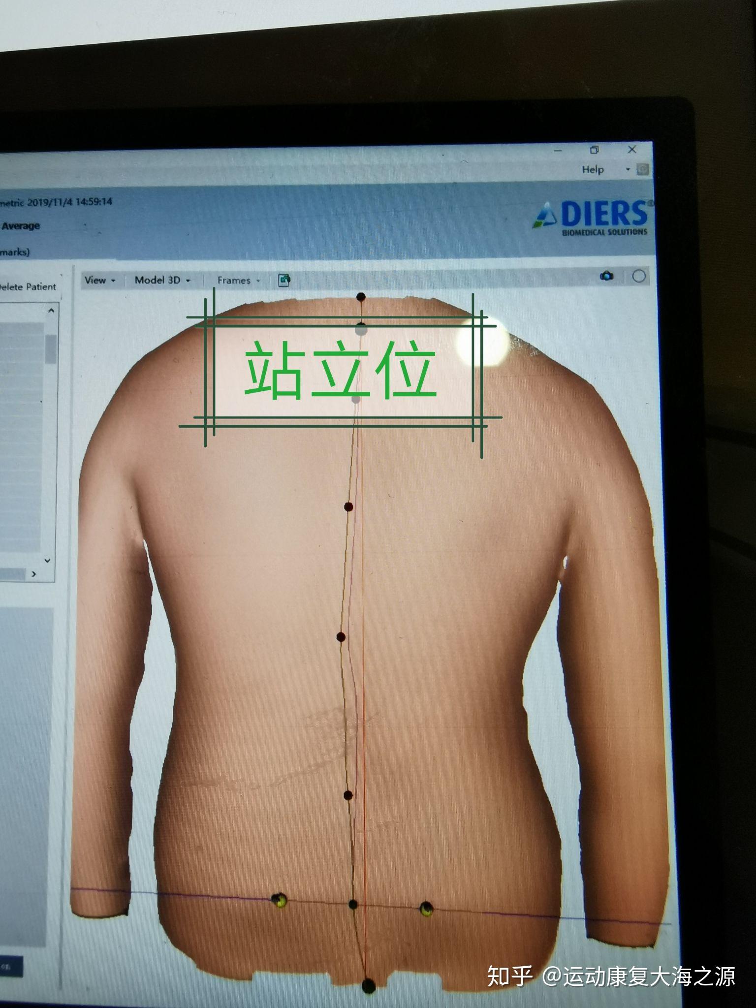 有一种脊柱侧弯叫功能性脊柱侧弯