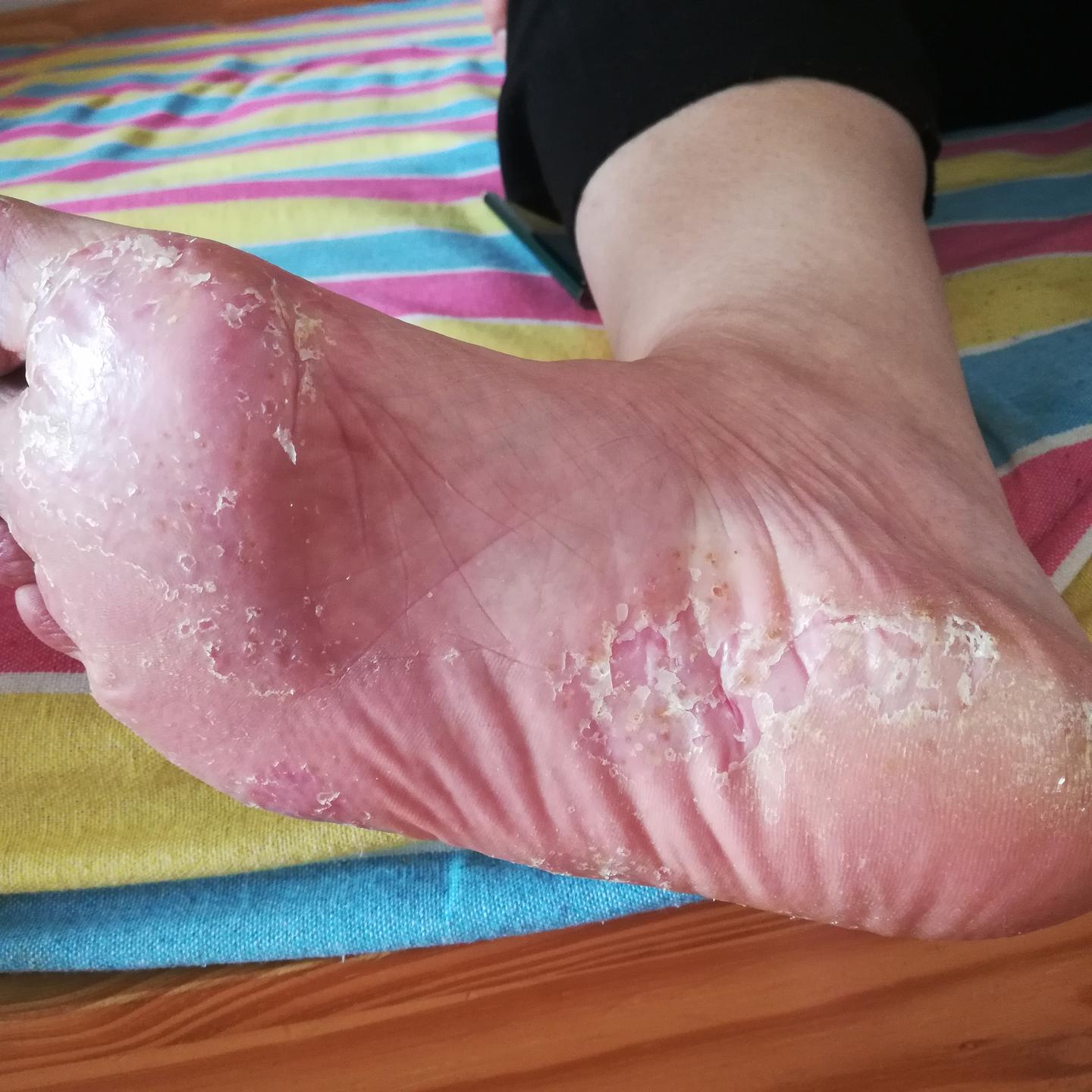 收藏中西医结合治疗掌跖脓疱病知识大全