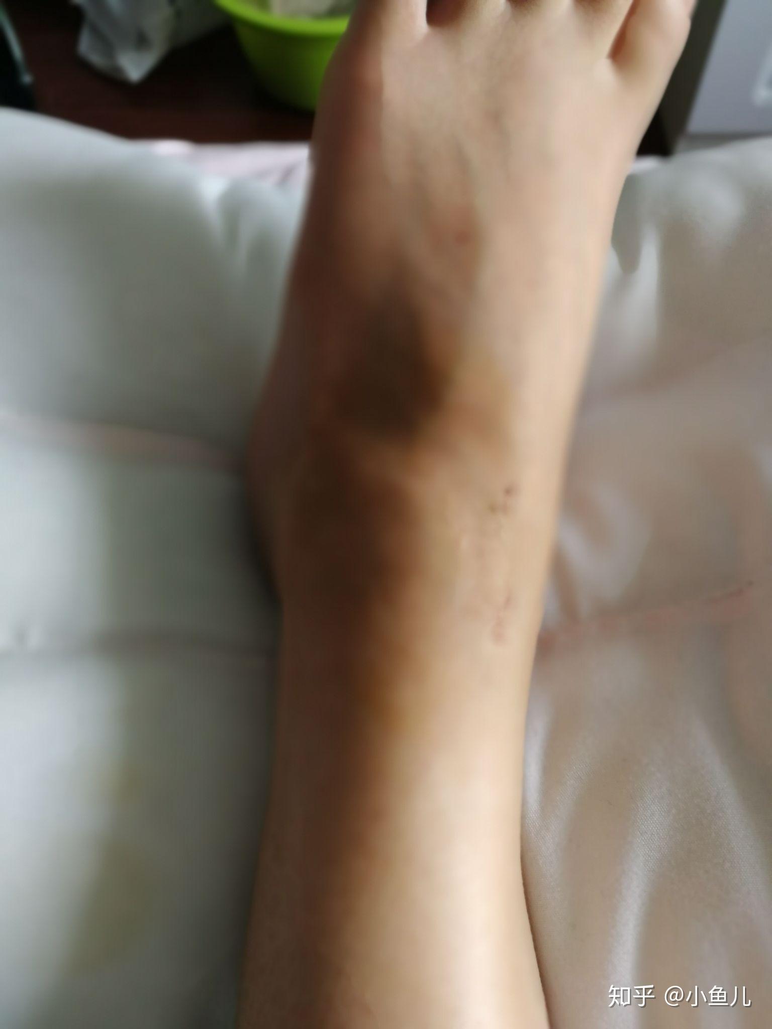 脚踝扭伤两个月了,核磁共振也做了,现在还是有些肿,走路也酸痛怎么办?