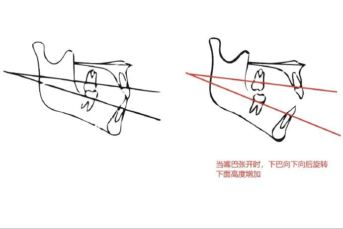 正畸中压低下后牙实现下颌逆旋对前凸上牙暴露量小需要伸长上前牙患者