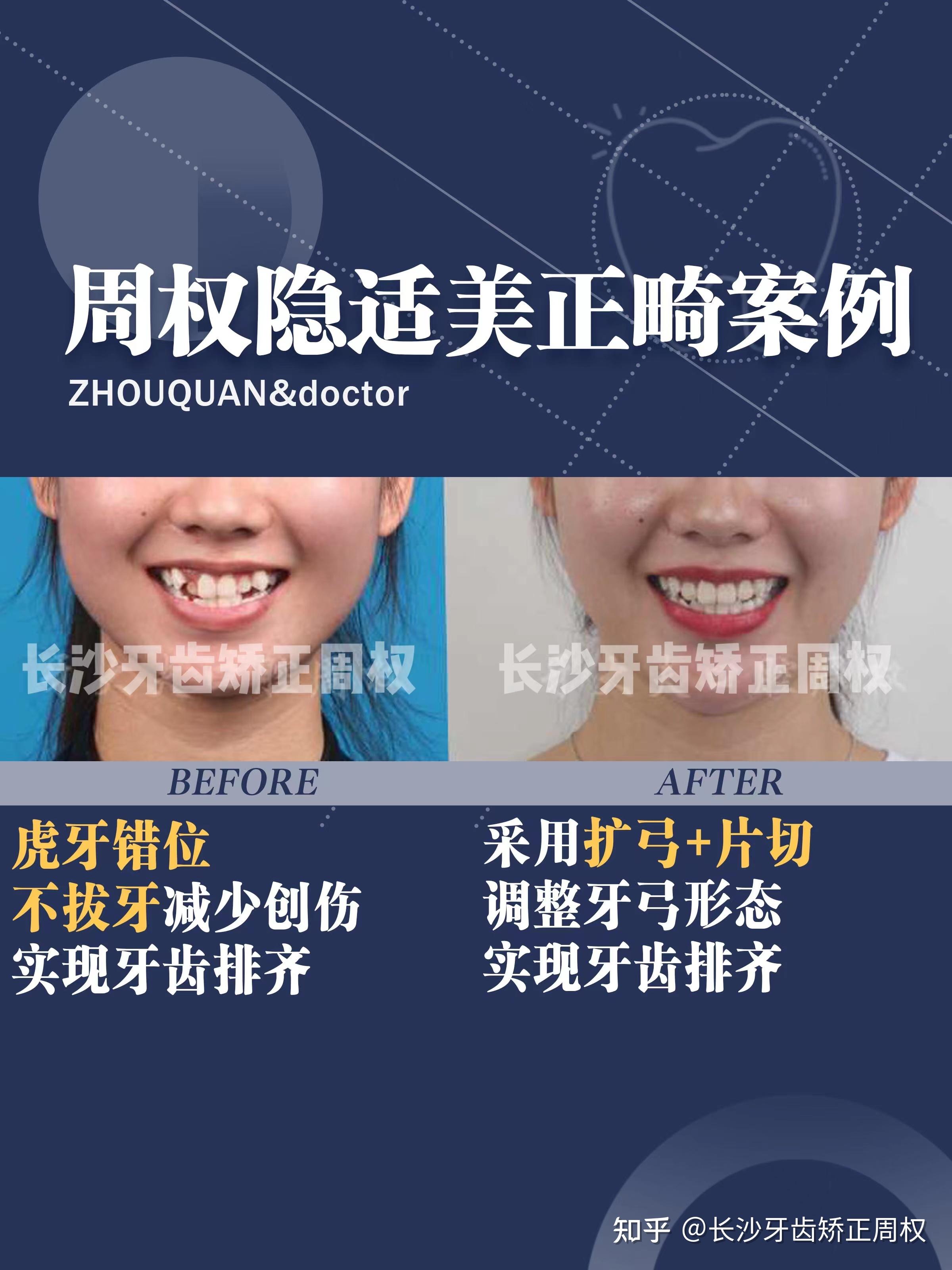 面部嘴角下垂_嘴角下垂面部凹陷图片_嘴角下垂面部松弛怎么改善