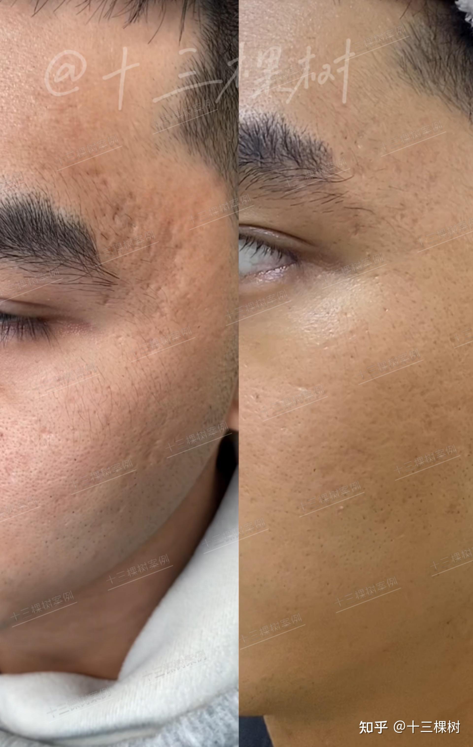 太阳穴痘坑 脸部痘坑已达10年!两组联合激光修复后的变化—— - 知乎