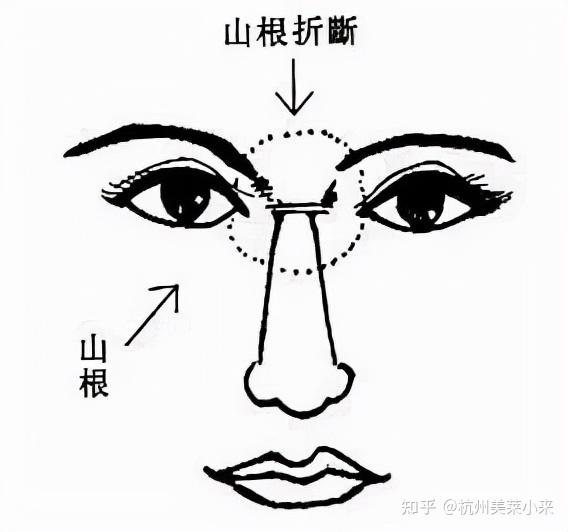 隆鼻显不显假看山根关于山根你知道多少