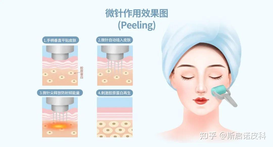 抗衰神奇-黄金微针了解一下 - 知乎