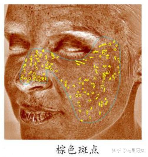 医美科普 检测皮肤的visia检测报告应该怎么看 知乎